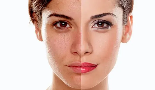 Acne treatment in Kumasi