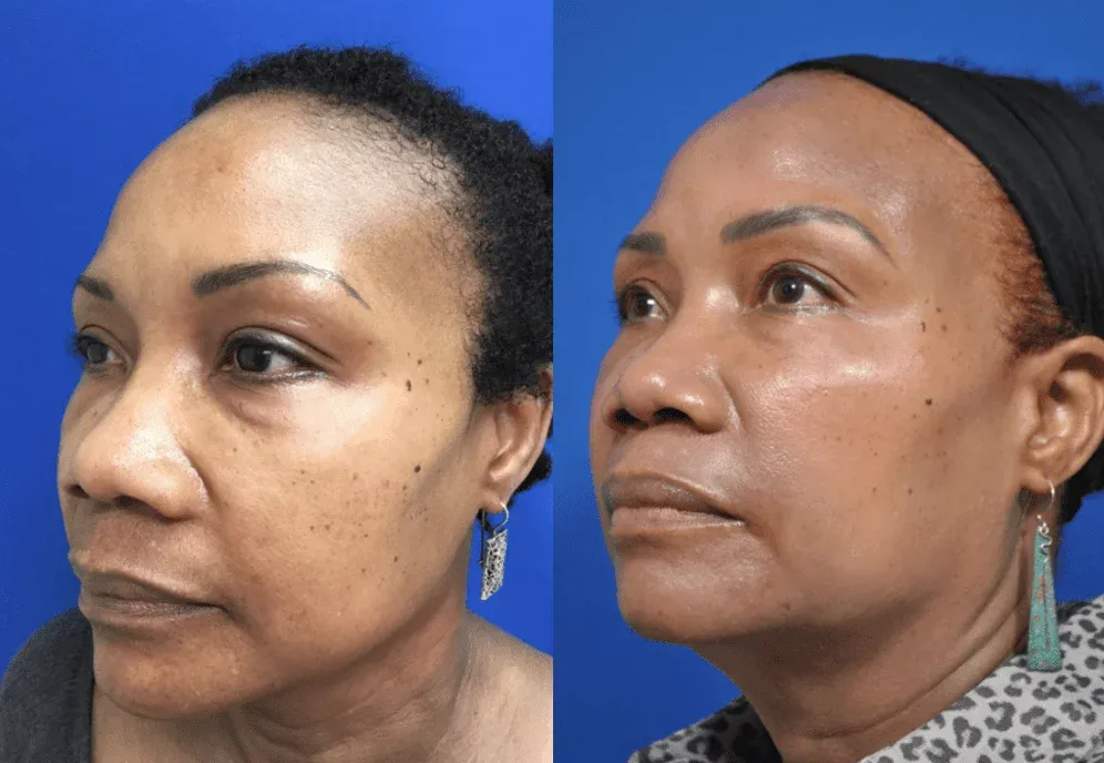 Dermal fillers in Kumasi