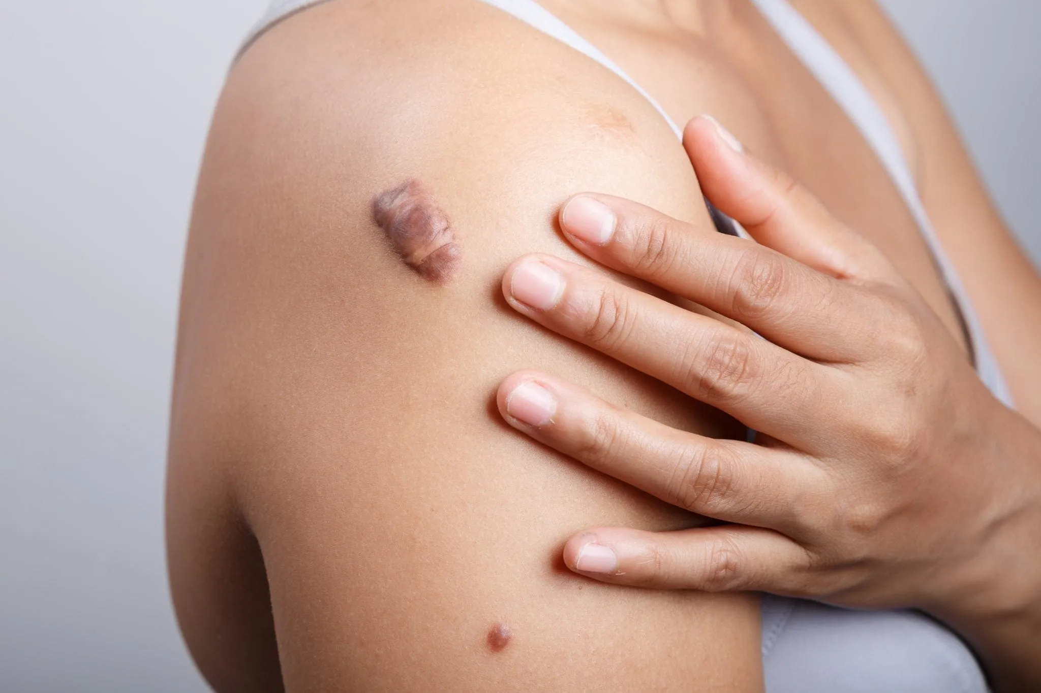 Skin tag & mole removal in Kumasi