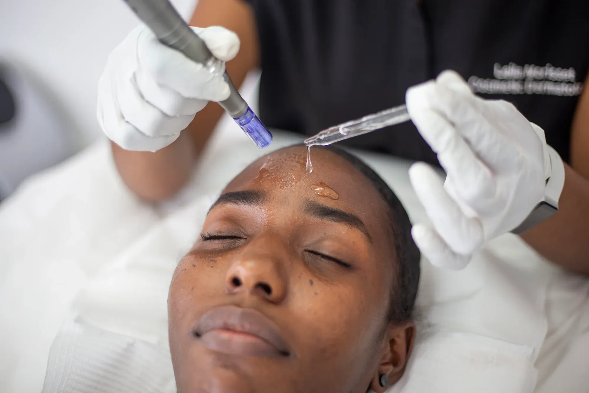 Microneedling in Kumasi