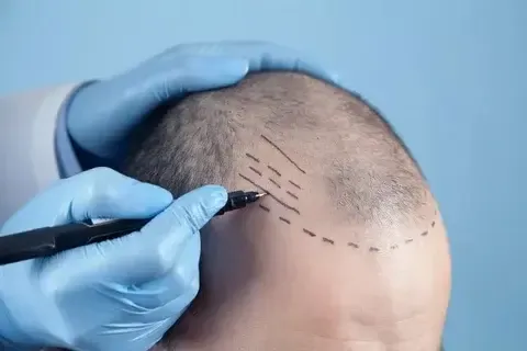 Hair transplant in Kumasi